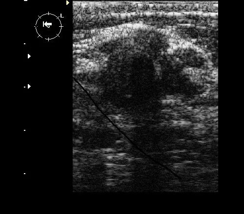 Фиброаденома молочной железы узи анатомия. Узи гипоэхогенное образование молочной железы. Листовидная форма фиброаденомы молочной железы. Узловая опухоль молочной железы. Листовидная форма фиброаденомы молочной железы.