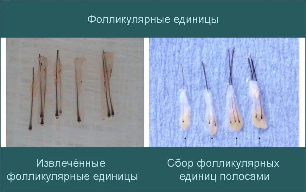 Картинки ЛУКОВИЦА ВОЛОСА ФОТО