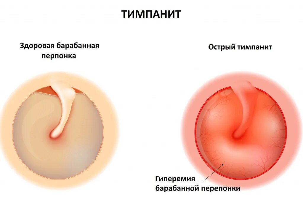 Стадии среднего гнойного отита. Острый Гнойный перфоративный средний отит. Острый средний отит отоскопия. Гнойный отит барабанная перепонка. Острый средний отит барабанная перепонка.