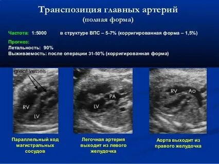Транспозиция магистральных сосудов у детей