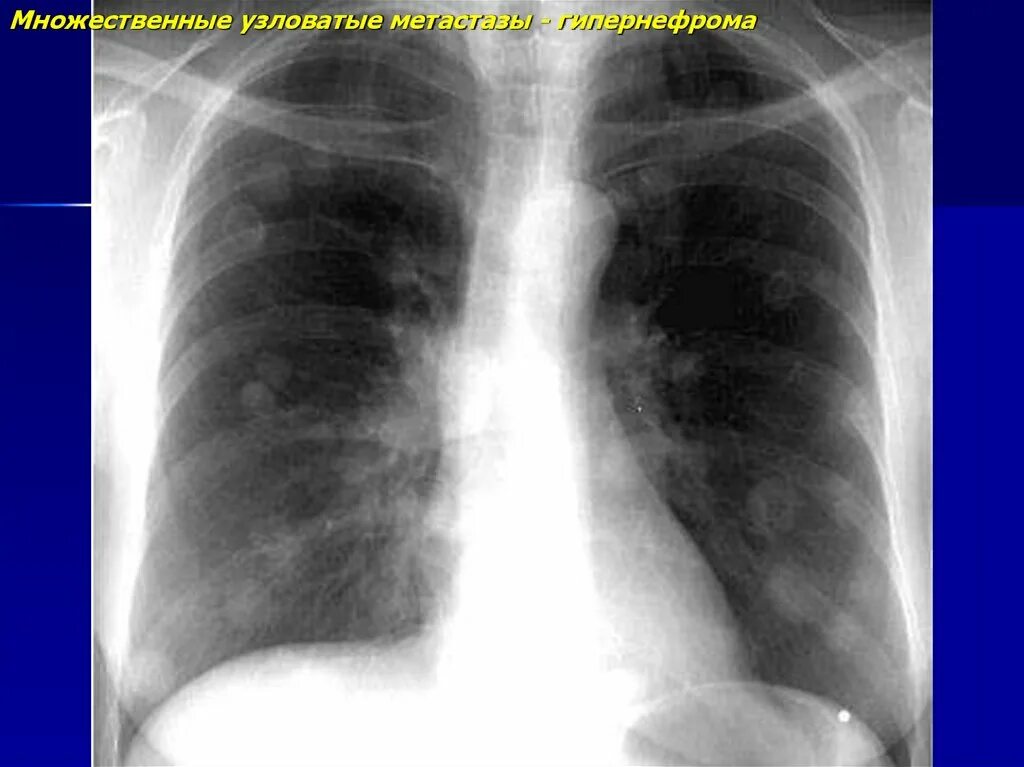 Множественные метастазы. Множественные метастазы в легкие. Множественные метастазы в легких рентген.