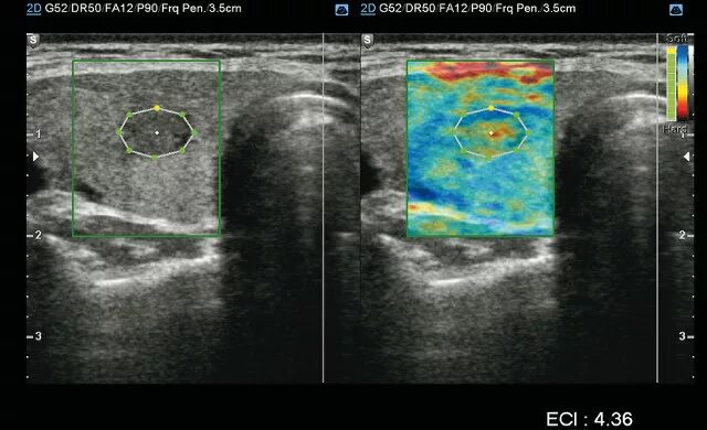Эластометрия щитовидной железы. Эластография щитовидной. Эластография щитовидной железы что это такое. Папиллярная карцинома щитовидной железы УЗИ.