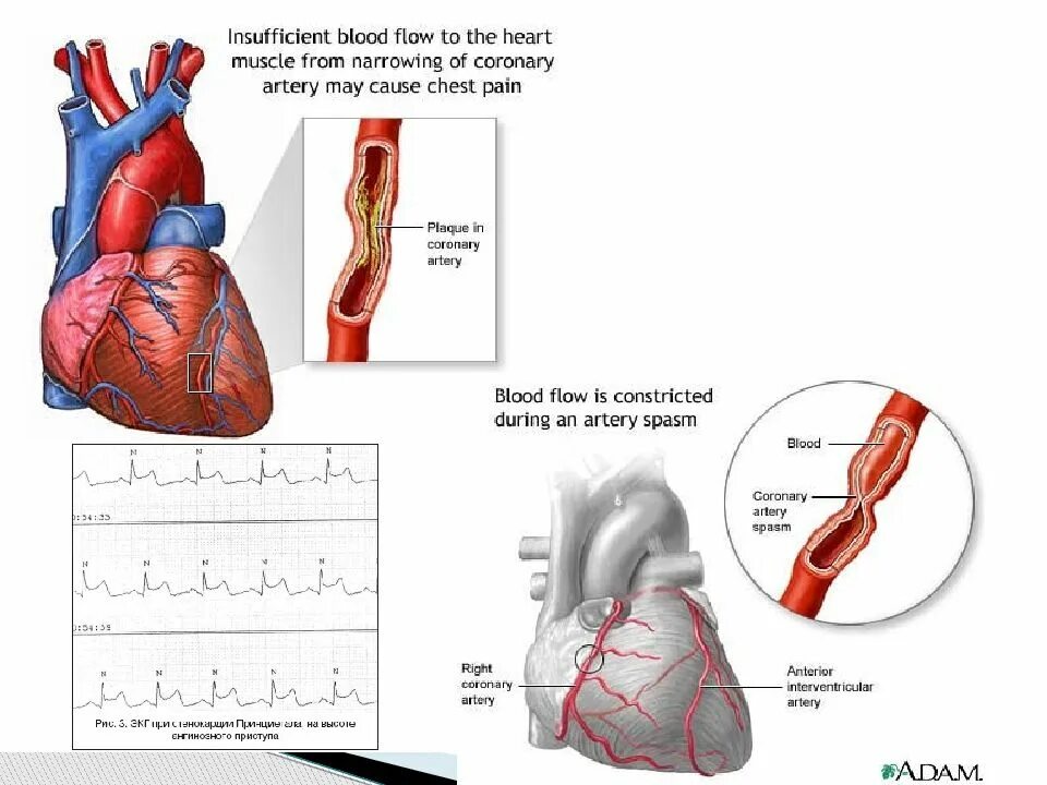 Острая сердечная коронарная недостаточность. Острый коронарный синдром. Коронарный генез изменений.