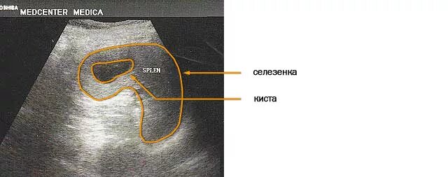 Селезенка кота. Спленомегалия селезенки УЗИ. Добавочная долька селезенки на УЗИ. Селезенка топография УЗИ. Миелолипома селезенки УЗИ.