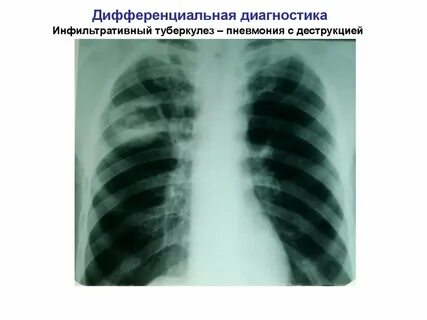 Легкие диф