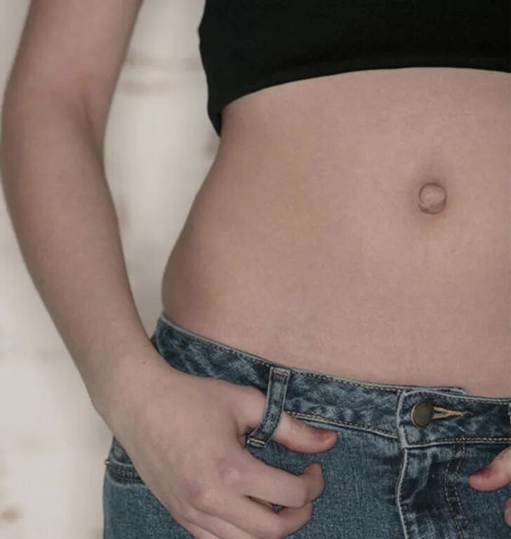 Живот после кесоревосечения. Некрасивый женский живот. Поро деформация живота. Пирсинг пупочной грыжи. Абдоминопластика грыжа и диастаз.
