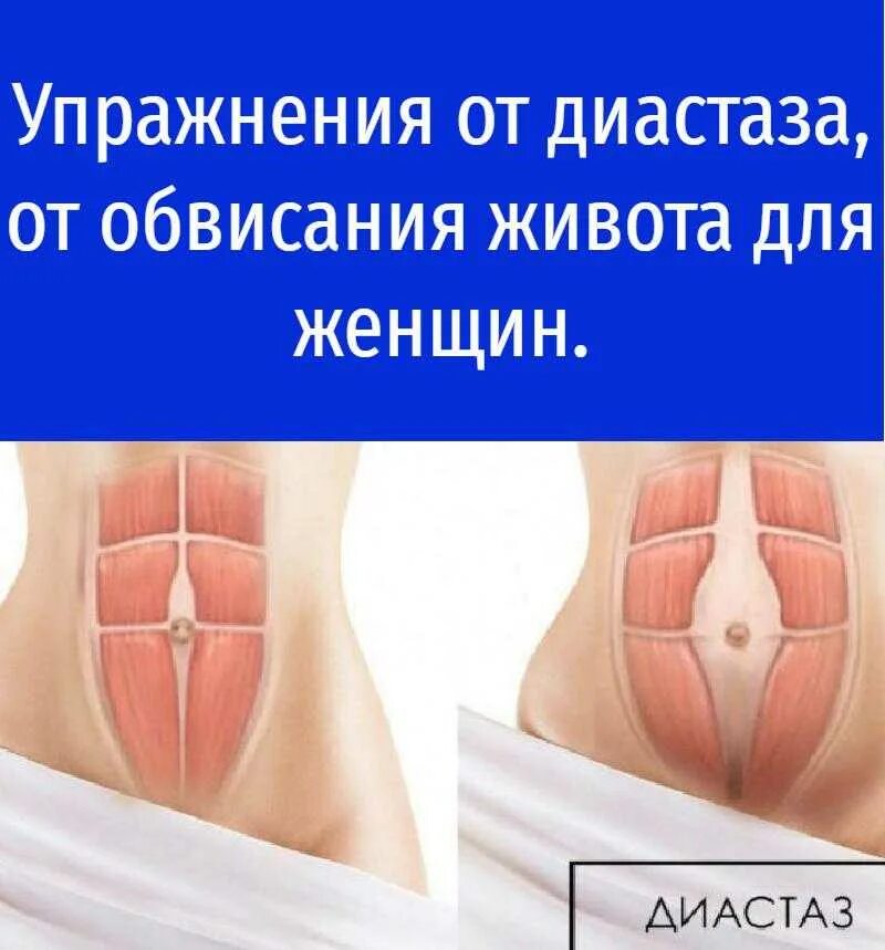 Диастаз прямых. Ушивание диастаза прямых мышц.