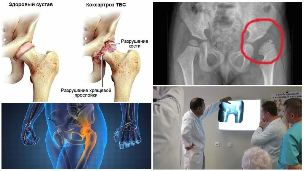 Больной сустав тазобедренный. Протрузионный коксартроз. Коксартроз тазобедренного сустава 2 степени. Тазобедренный сустав коксарартроз. Левосторонний коксартроз 3 степени.