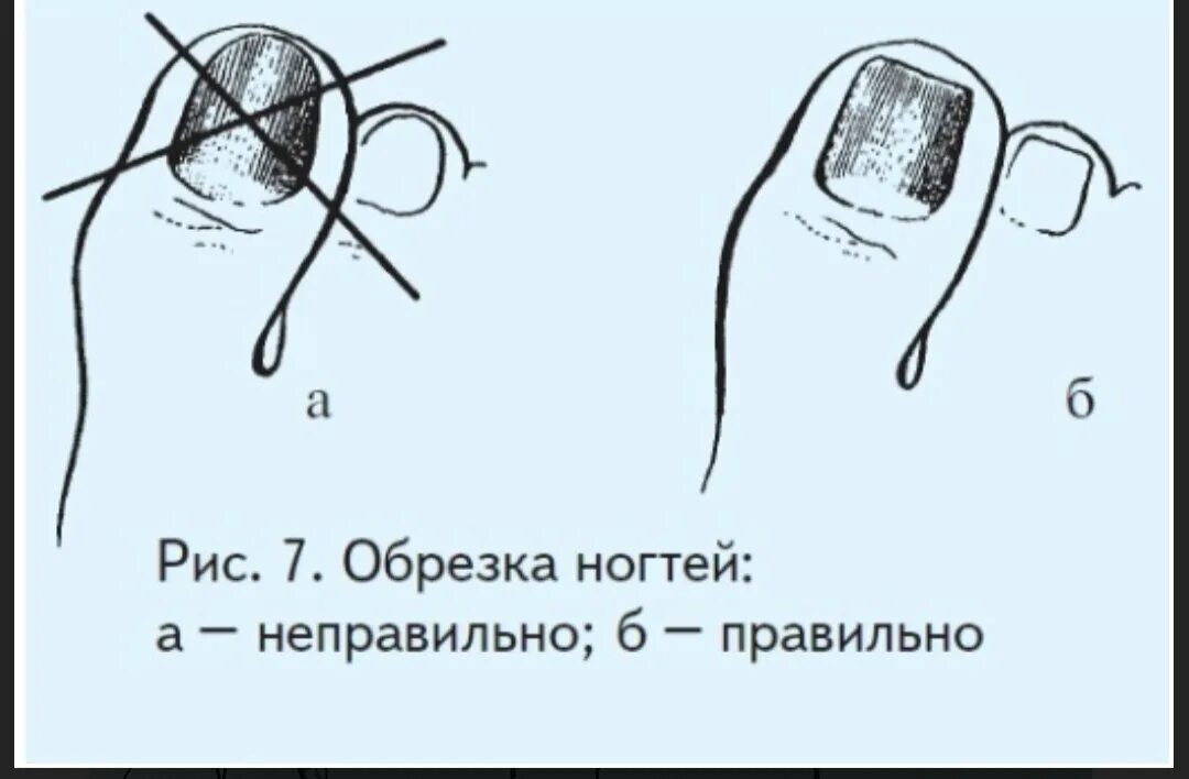 Как подстригать ноготь большого пальца ноги. Как правильно подстригать ногти на ногах. Схема стрижки ногтей. Как правильно подстригать ногти. Правильно подстриженные ногти на ногах.