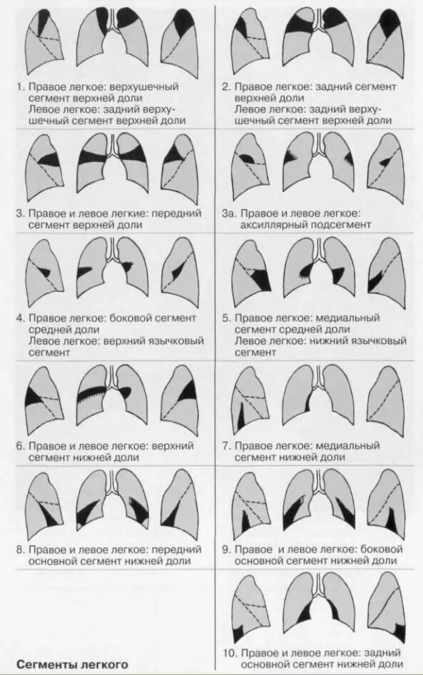 Доли легкого на рентгенограмме. Сегменты и доли легкого на рентгенограмме схема. Сегменты лёгких на рентгене. Доли легкого и сегменты на рентгене. Доли и сегменты легких на рентгенограмме.