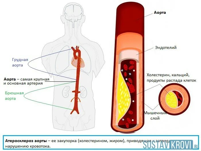 Как лечить атеросклероз брюшного отдела аорты. Клинические проявления атеросклероза аорты. атеросклероз дуги грудной аорты. атеросклероз брюшного отдела аорты симптомы. атеросклеротические изменения грудного отдела аорты.
