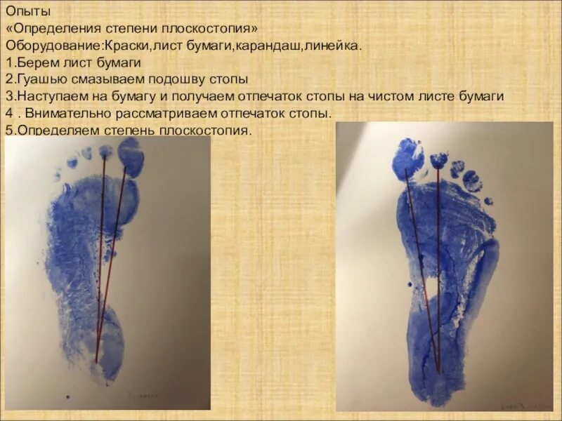 Как определить плоскостопие по отпечатку. Плантограмма плоскостопия 3 степени. отпечаток стопы 3 степени плоскостопия. выявление плоскостопия по отпечатку стопы. эксперимент на выявление плоскостопия.