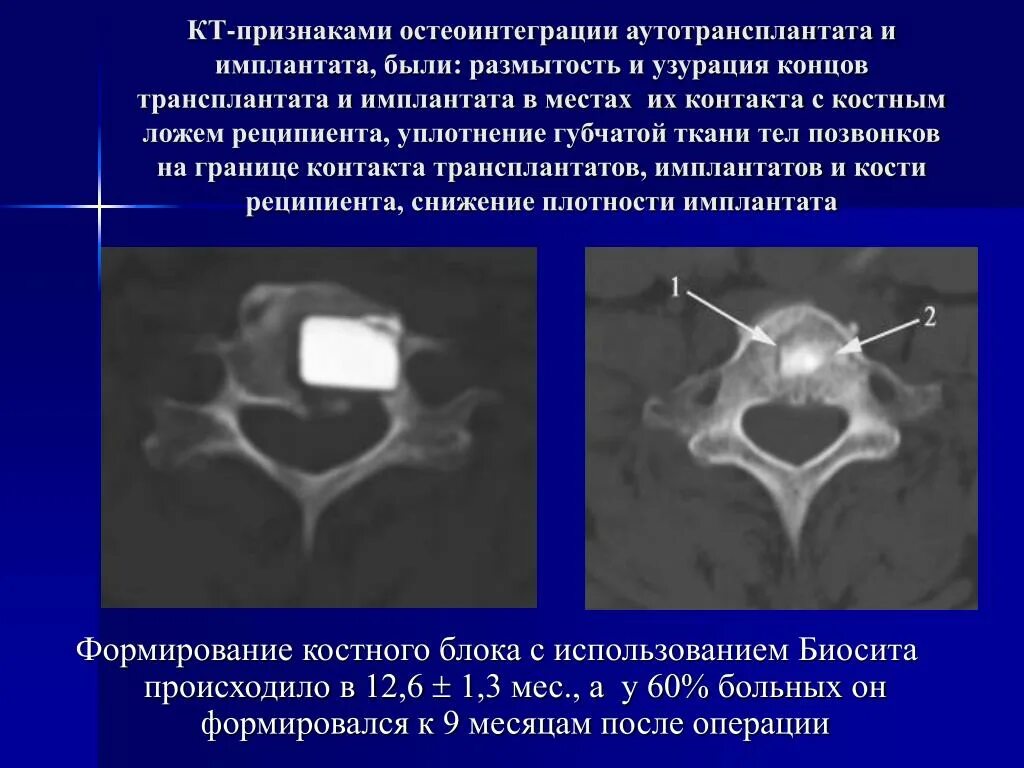 Костная ложа
