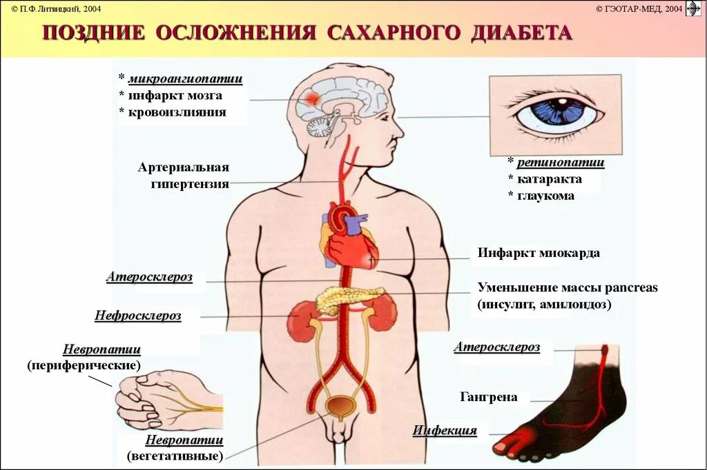 Диабет без осложнений. Органы мишени сахарного диабета 1 типа. Осложнения сахарного диабета. Осложнения сахарного диабета 1. Осложнения СД.