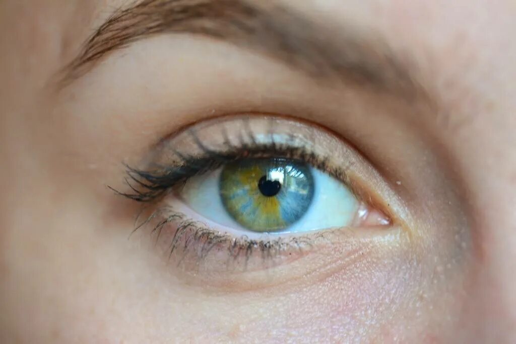 Худший цвет глаз. Металлозная гетерохромия. Секторная гетерохромия глаза. Секторпльная геторолхоромия. Центральная гетерохромия карих глаз.