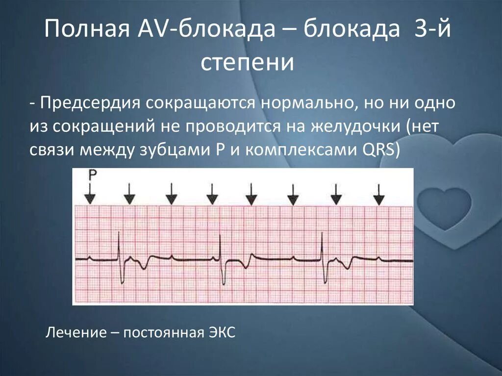 Комплекс блокада. Полная av блокада на ЭКГ. Аб блокада 3 степени ЭКГ. АВ блокада 3 на ЭКГ. Атриовентрикулярная блокада III степени (полная АВ-блокада).