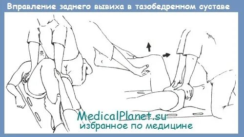 Код мкб вывих тазобедренного сустава. Вправление тазобедренного сустава самостоятельно. вправление вывиха тазобедренного сустава по джанелидзе. вправление вывиха бедра методом кохера.