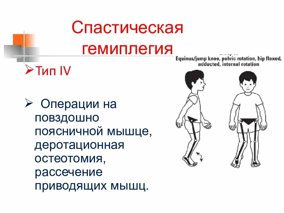 Спастическая гемиплегия. Спастическая гемиплегия симптомы. Спастическая гемиплегия ДЦП. Правосторонняя гемиплегия симптомы.