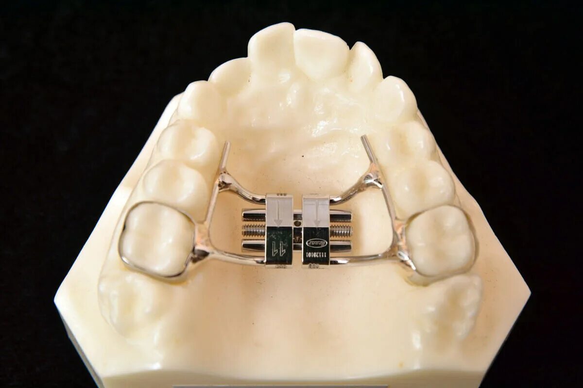 Аппарат Дерихсвайлера. Аппарат Дерихсвайлера (Марко Росса). Аппарат для расширения верхней челюсти Дерихсвайлера. Аппарат Дерихсвайлера ортодонтия. Расширение челюсти цена
