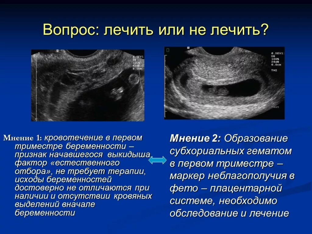 Ретрохориальная гематома на УЗИ. Ретрохориальная гематома признаки. Ретрохориальной гематомы при беременности. Кровить 6 недель беременности