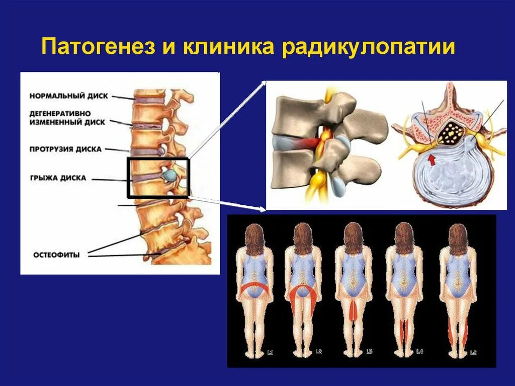 Радикулопатия справа. Радикулопатии l4 l5 s1. Синдром радикулопатии. Симптомы радикулопатии. Клинические симптомы радикулопатии.