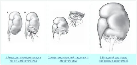 Резекция правой почки