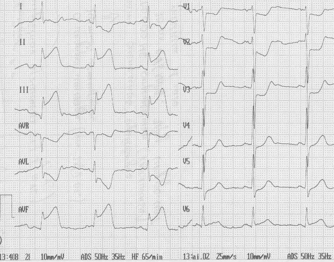 St ишемия. ОИМ задней стенки ЭКГ. Инфаркт миокарда нижней стенки ЭКГ. Нижний инфаркт миокарда на ЭКГ. ЭКГ при Нижнем инфаркте миокарда левого желудочка.