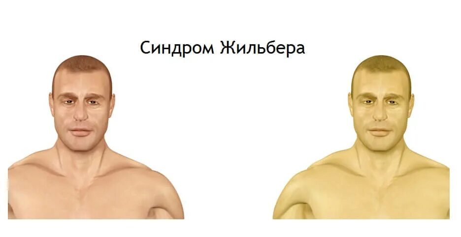 Синдром жильбера симптомы. Жильбера синдром жильбера. признаки жильбера синдром жильбера.