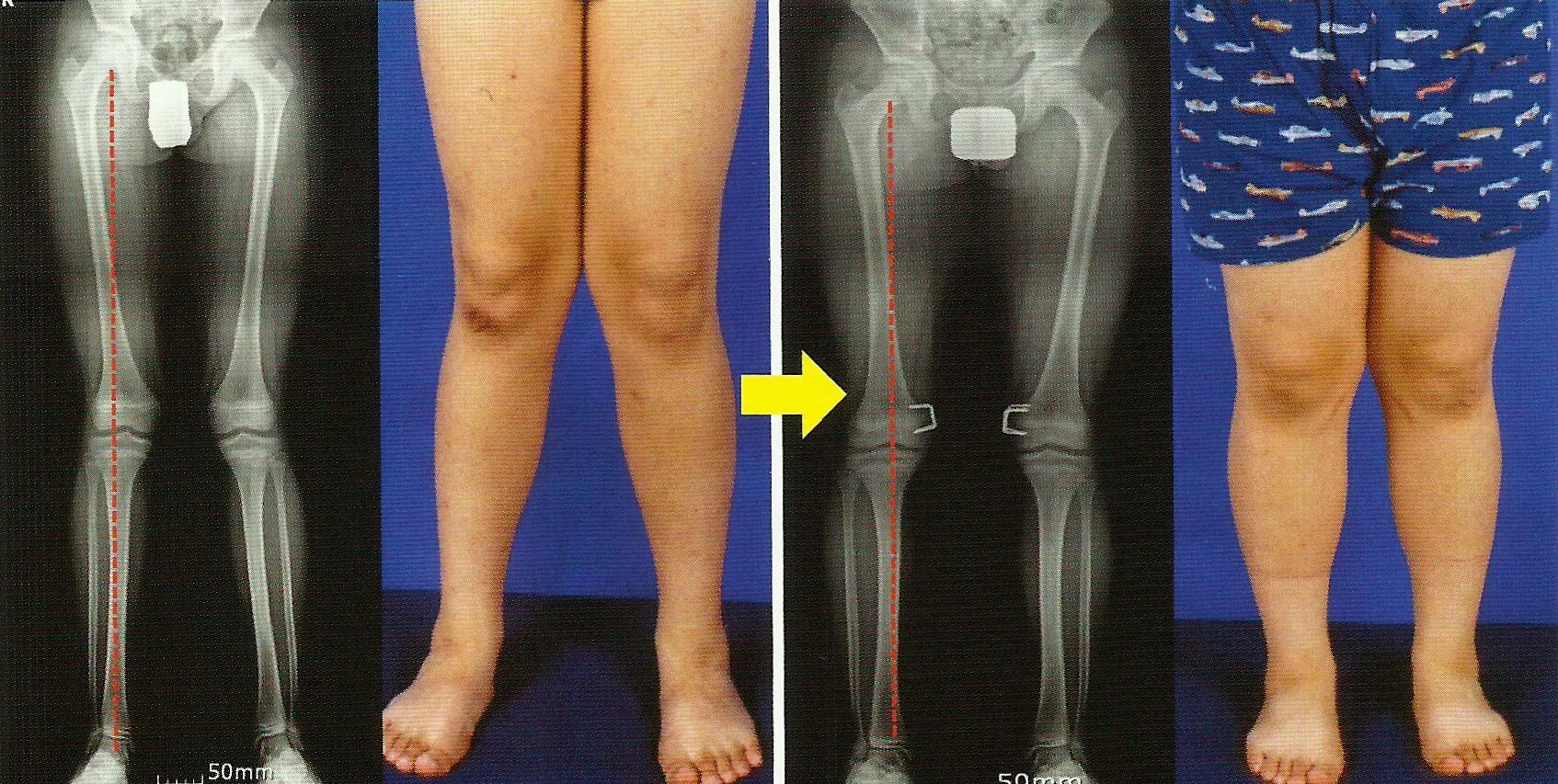 Вальгусная и варусная деформация. Вальгус коленных суставов. Варусная дисплазия коленных суставов. Варусная и вальгусная деформация коленного сустава. Болезнь суставов у взрослых