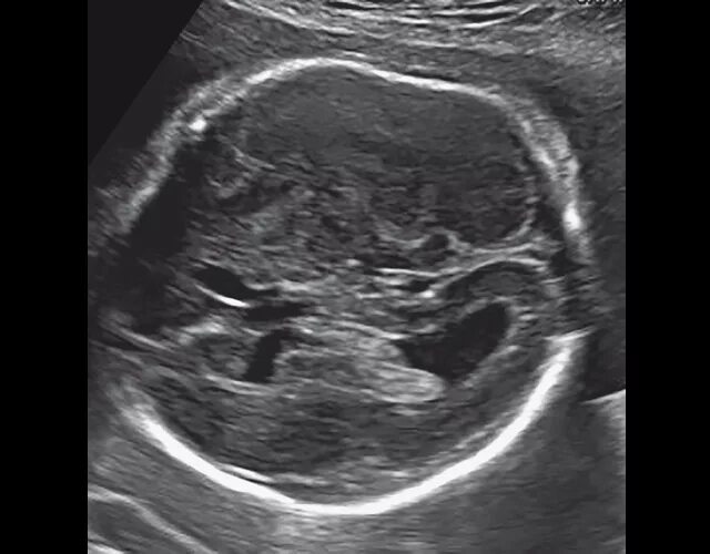 Скелетная дисплазия у плода на узи. Кистозная дисплазия почек узи. Сильвиева борозда узи. Скелетная дисплазия у плода. Поликистозная дисплазия.