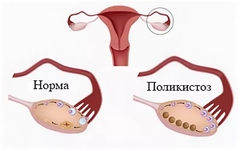 Как лечить дисфункцию яичников. Болит яичник при овуляции. боли при поликистозе яичников.