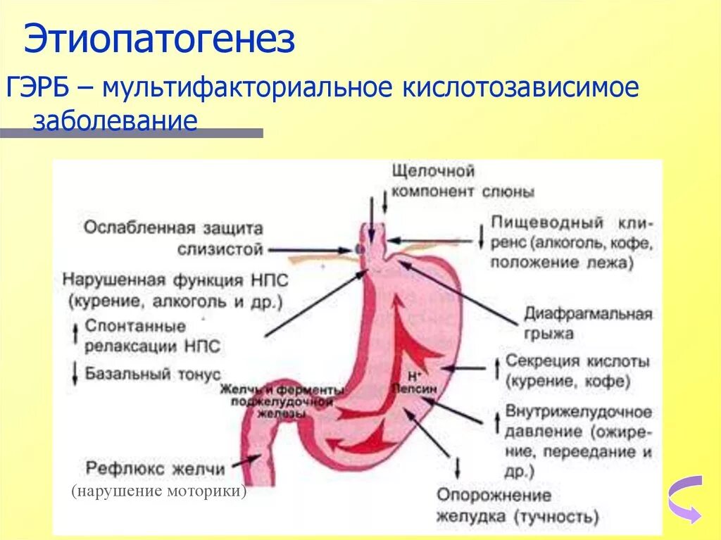 Забросы из желудка в пищевод симптомы. Рефлюкс эзофагит 4 степени. Гиперемия слизистой оболочки пищевода. Желудочно-пищеводный рефлюкс этиология. ГЭРБ механизм развития.