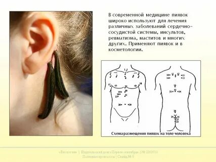 Как правильно ставить пиявок схема