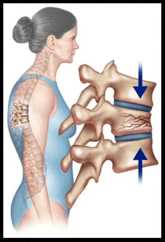 Лечение последствия компрессионного перелома позвоночника. Компрессионный перелом позвоночника th11-l1. Компрессионный перелом д6 позвонка неврологические. Компрессионные переломы тел l1 l2. Компрессионный перелом 6 позвонка.