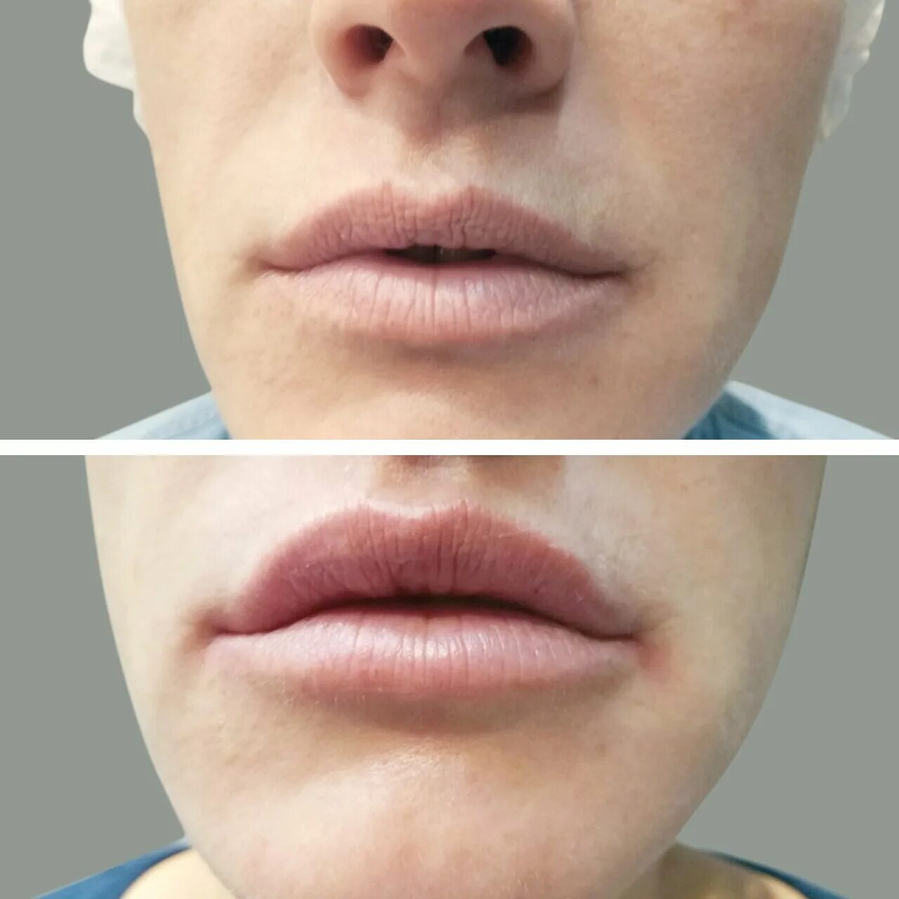 Коррекция губ. Уголки губ гиалуроновой кислотой. Контурная пластика губ гиалуроновой. Губы до и после увеличения гиалуроновой кислоты