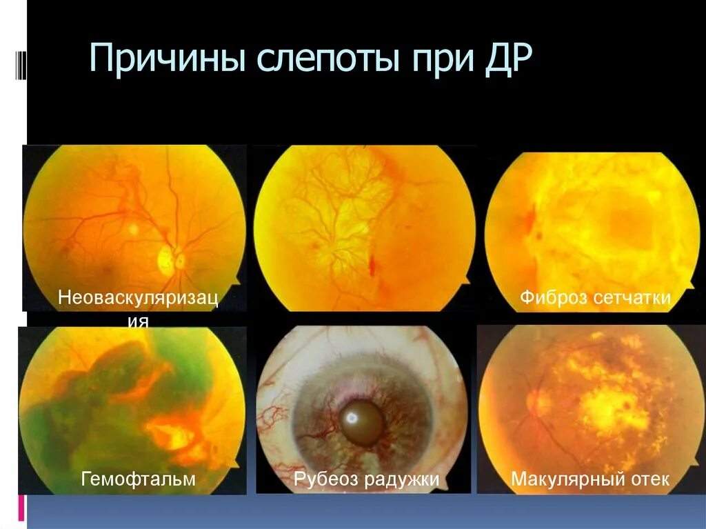 Почему слепота