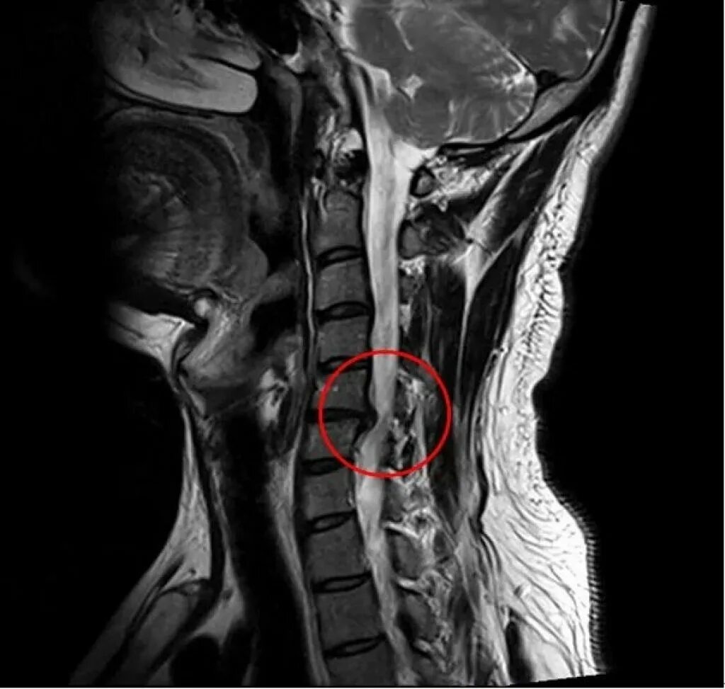 Хандроз спинного и шейного отдела позвоночника. Шейный отдел позвоночника c5-c6. Вертеброгенная миелопатия. Грыжи межпозвонковых дисков шейного отдела с3 с5 с6. Межпозвонковые диски c5 c6 c7.