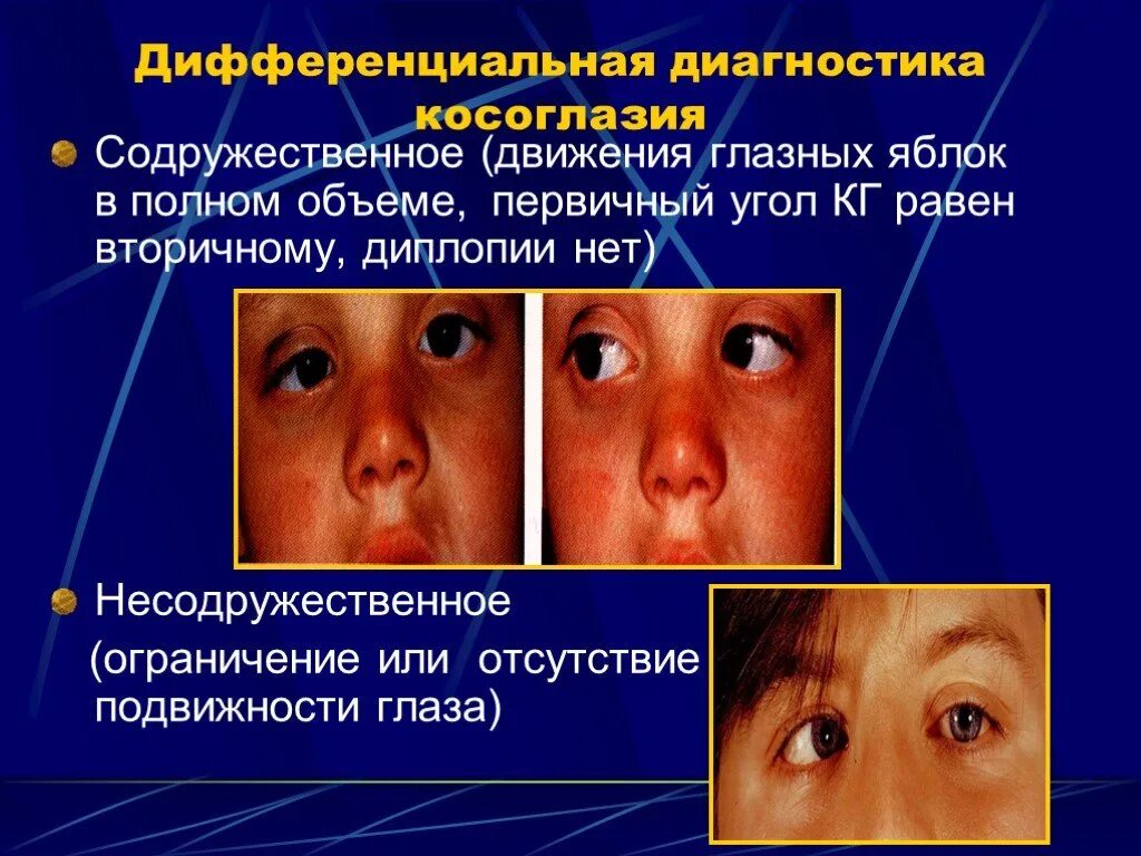 Нарушение движений глазных яблок