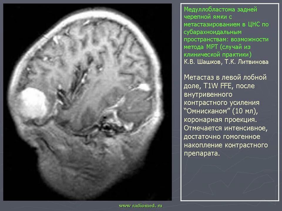 Медуллобластома это. Медуллобластома это