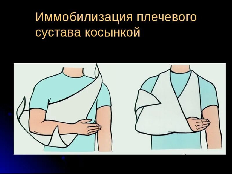 Иммобилизации при вывихах суставов конечностей