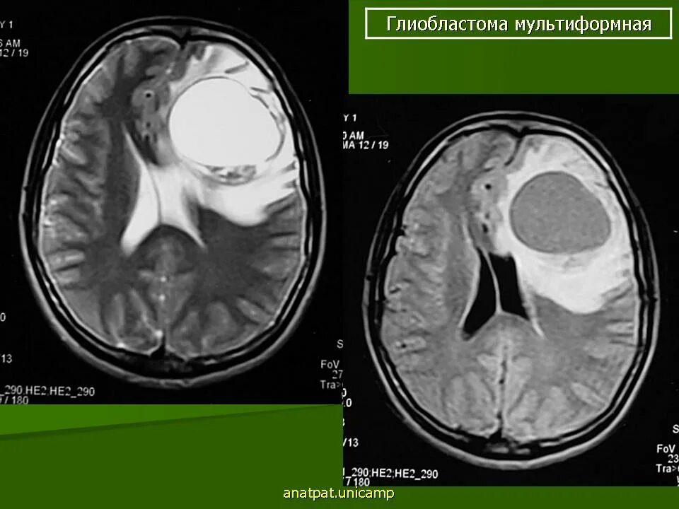 Мультиформная глиобластома. Опухоль головного мозга глиобластома. Глиобластома 4 степени.