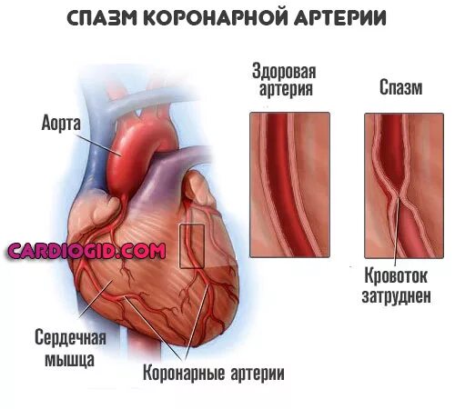 Коронарные артерии сужения корон. Спазм коронарных сосудов сердца симптомы. Спазм венечных артерий. Стеноз венечных артерий.