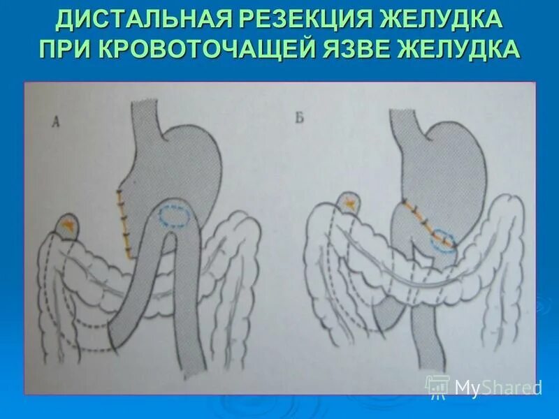Язва после резекции желудка. Язва после резекции желудка. Пептическая язва причины. Язва после резекции желудка. После резекции желудка.