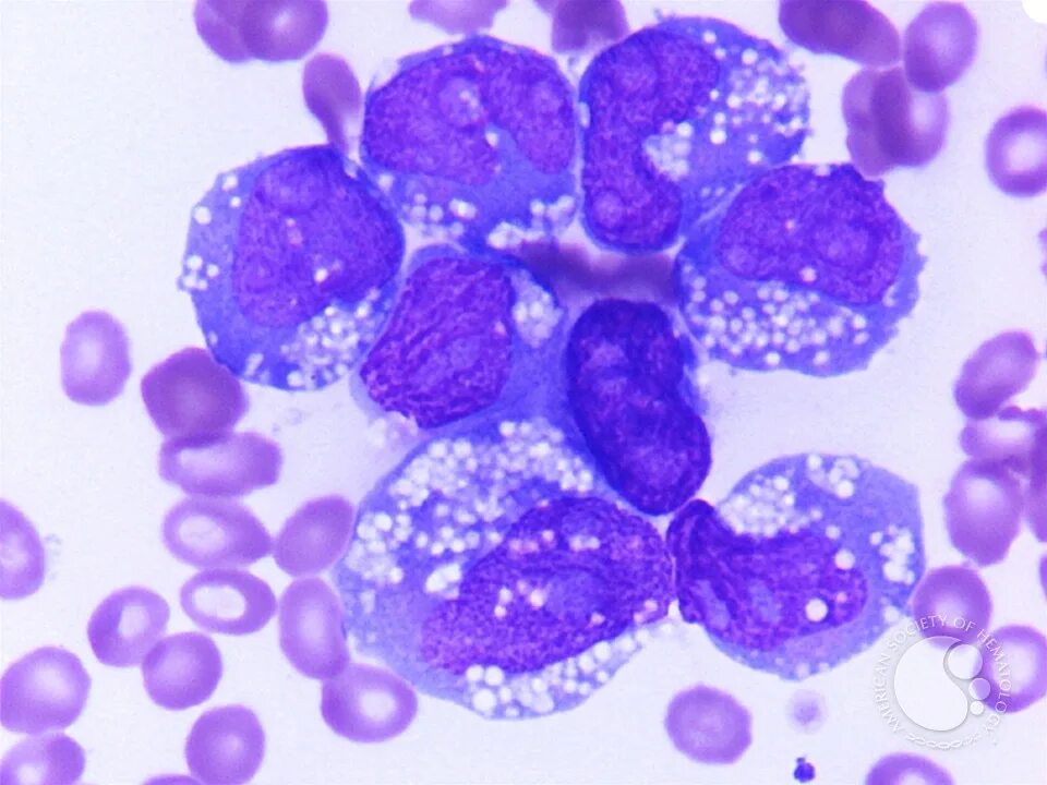 Leukemia