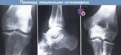 Остеонекроз лечение