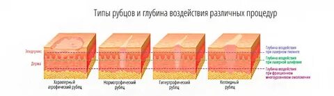 Косметическое удаление верхнего слоя кожи