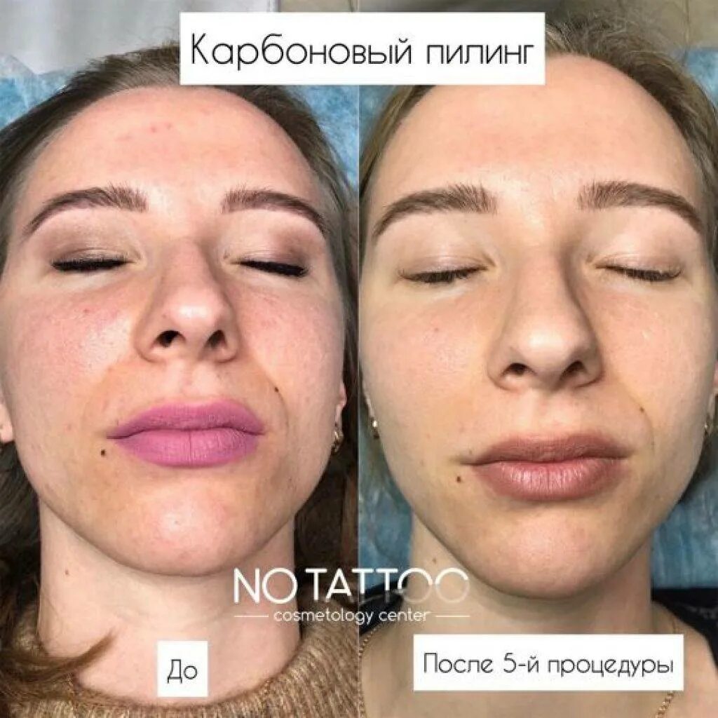 Карбоновый пилинг отзывы до и после Карбоновый пилинг: фото до и после, отзывы (лазерный карбоновый пилинг)