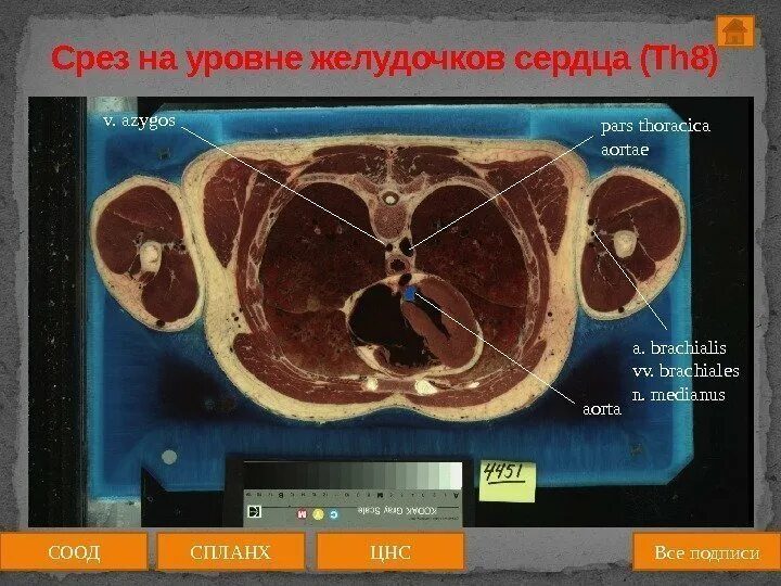 Срезы музыка. Пироговские срезы анатомия. срез сердца на уровне клапанов.