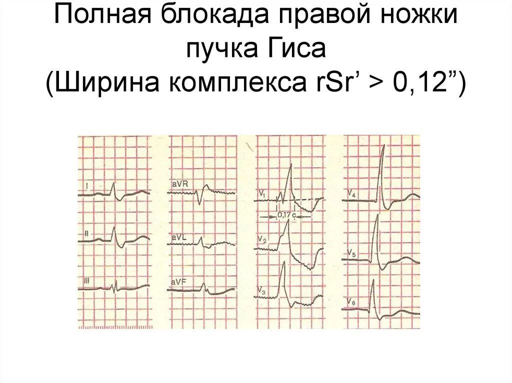 Частичная блокада ножки пучка гиса