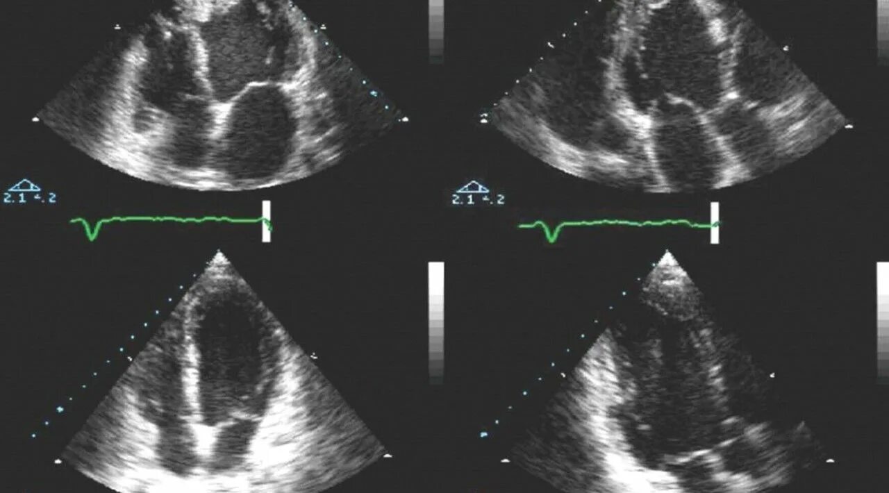 ЭХОКГ при миокардите. Эхокардиография при миокардите. ЭХОКГ УЗИ сердца. Эхокардиография Эхо кг УЗИ сердца. Эхо кс цена